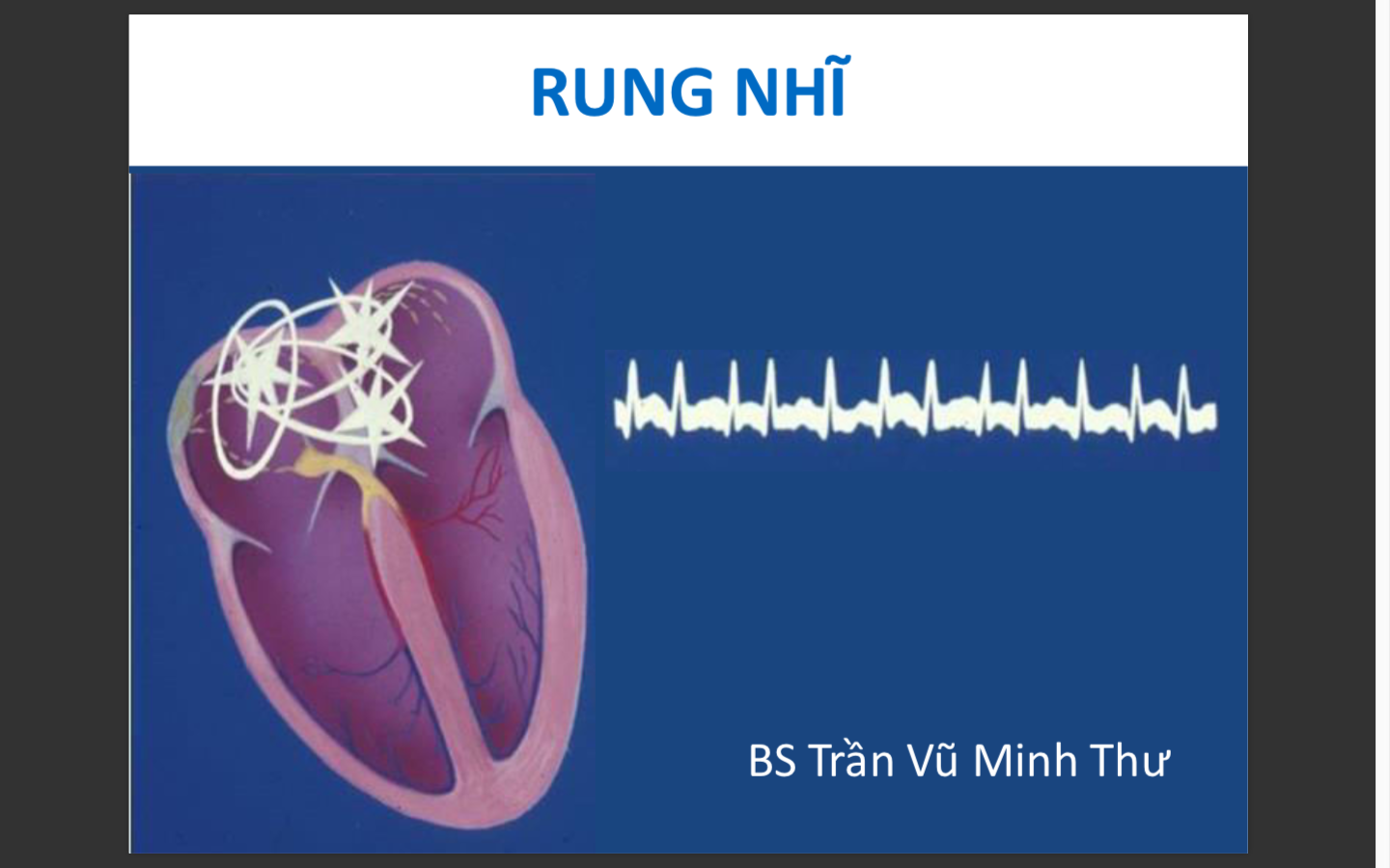 ECG rung nhĩ 2018