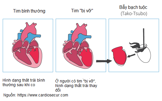 Bệnh cơ tim Takosubo