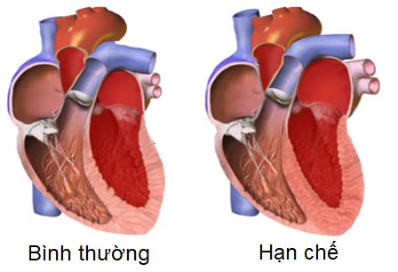 Bệnh cơ tim hạn chế