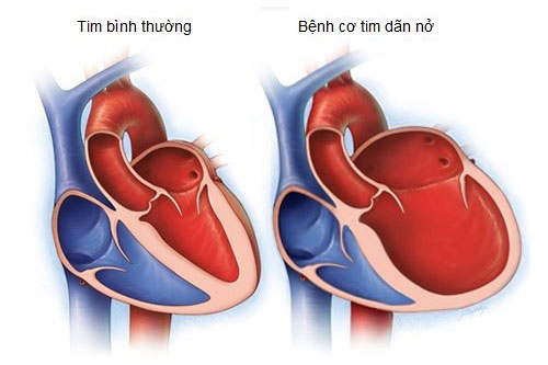 Bệnh Cơ Tim Dãn Nở