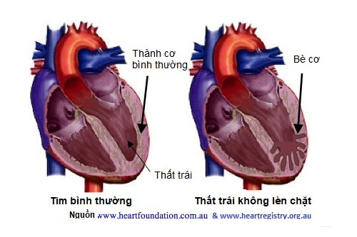 Bệnh Cơ Tim Không Lèn Chặt