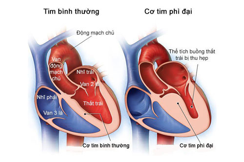 Bệnh Cơ Tim Phì Đại