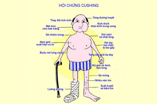 Hội Chứng Cushing