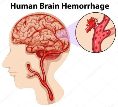 Xuất Huyết Não