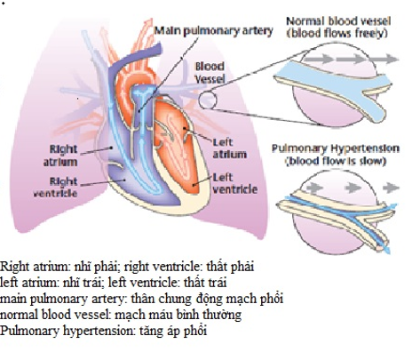 Tăng Áp Động Mạch Phổi