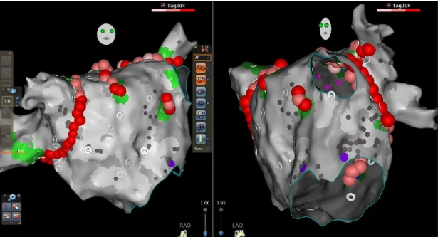 Điều trị rung nhĩ