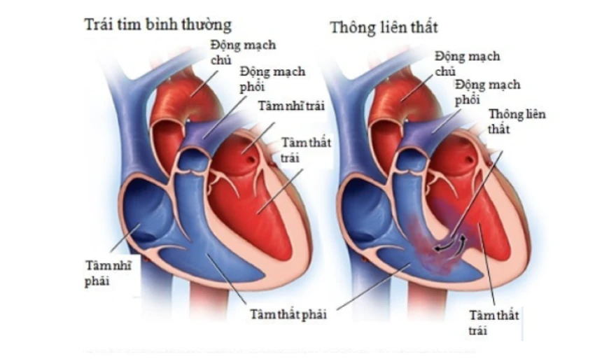 thông liên thất