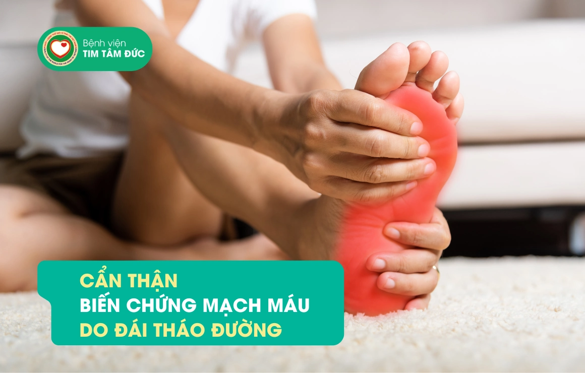 Cẩn thận biến chứng mạch máu toàn thân do bệnh đái tháo đường